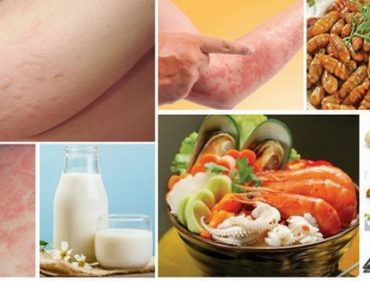 Ăn uống khi bị mề đay “hỏi thăm”_5ed3226bb031f.jpeg
